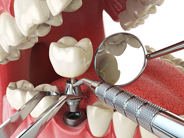 Best Emergency Denture Repair in Cottage Grove, MN